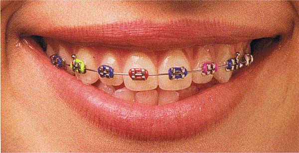 A close-up of a smiling mouth with braces featuring colorful brackets in green, blue, red, and pink against a neutral background.