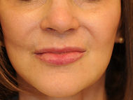 Lip lift Case 11 before 1 of 3.jpg
