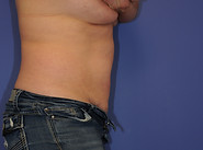 Case 24 Tummy Tuck Before Photo 3