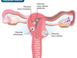Fibromes
