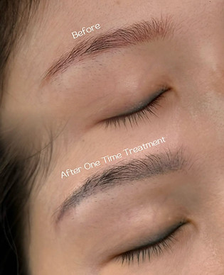 皮秒镭射洗眉.jpeg