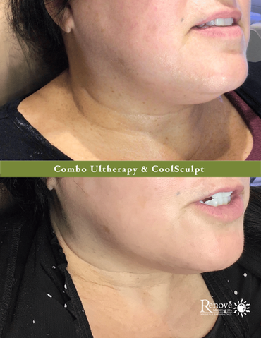 Before & After: Ultherapy & CoolSculpt Combo -Jowls