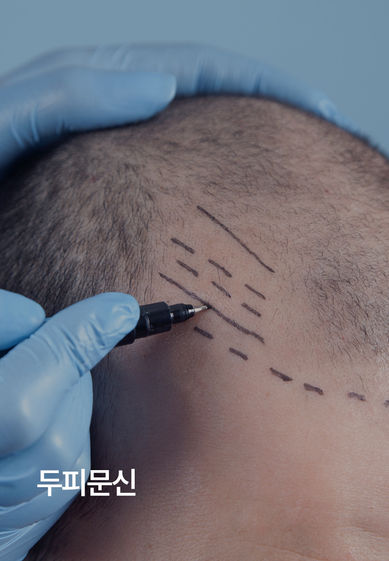두피문신