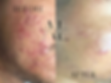 acne before and acne .png
