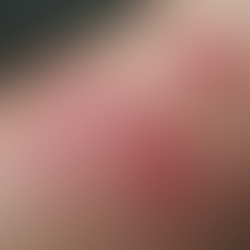 Understanding the Challenges of Living with Eczema