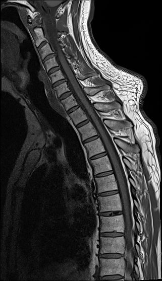 High-Resolution Sagittal Images Achieved with the Snuggle 1.5T MR Coil