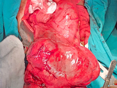 Giant Tumor of Stomach (GIST)