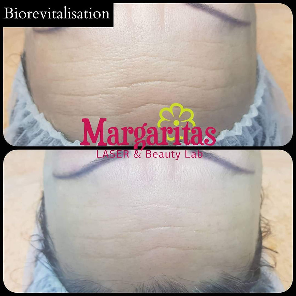 PRX-T33 no-needles Biorevitalisation