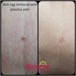 Plasma Pen treatment