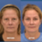 facelift-browlift-eyelid-surgery.001