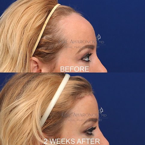 Hairline Lowering Surgery Forehead Reduction Surgery