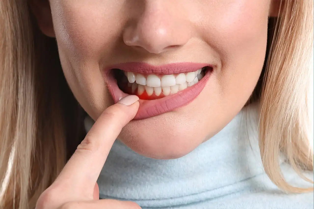 periodontitis.webp