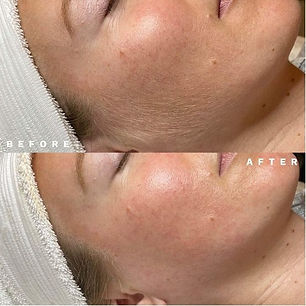 Dermaplaning