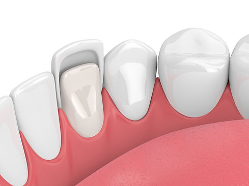 naminik-veneers.jpeg