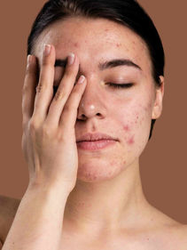 Tratamento Para Acne-min.jpg