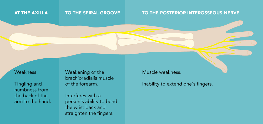 SYMPTOMS OF RADIAL NERVE INJURY