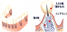 インプラントによる改善点