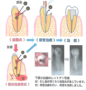 歯の根の治療(根管治療)