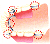 部分入れ歯