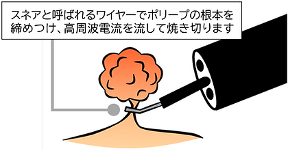 切除手術の説明