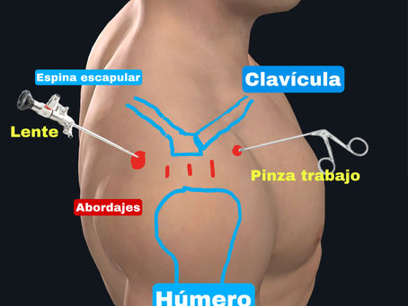 Que es la artroscopia de hombro?