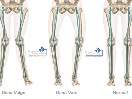 Deformidades de la rodilla.