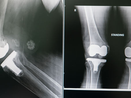 Tratamientos de Cartílago vs Prótesis de Rodilla