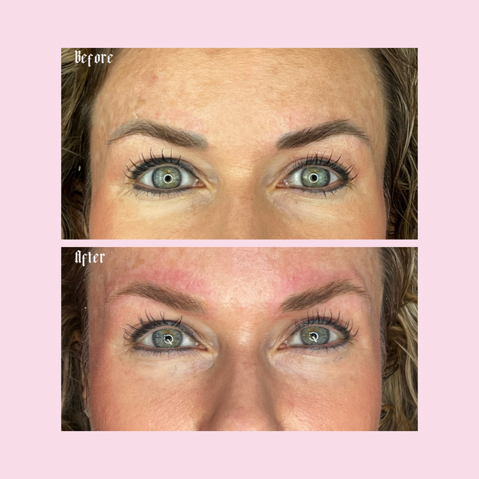 Brow Toning with laser tattoo removal to get the dark grey out of the ink.