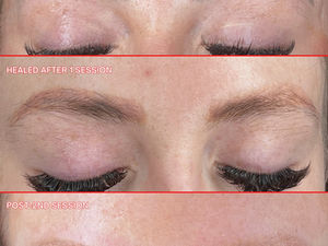 Saline Removal vs. Laser PMU Removal: Which Is Better for Removing Permanent Makeup?