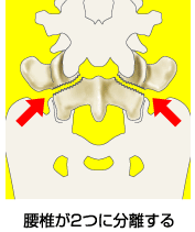 spondiyolysis.gif