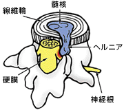 lumbar_disc_herniation_02.gif