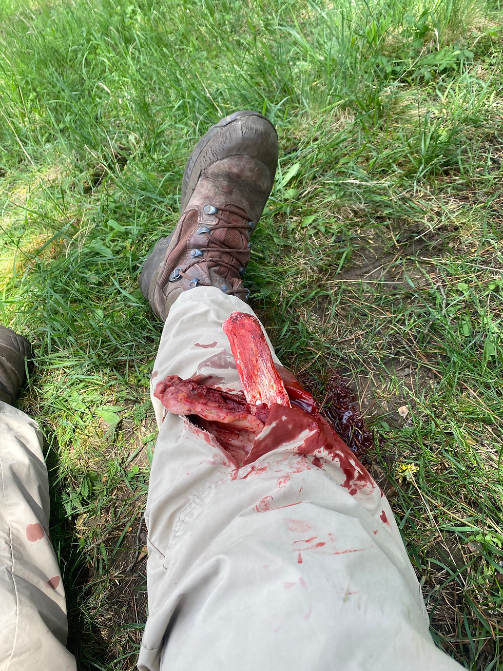 Thumbnail: Tibia open fracture