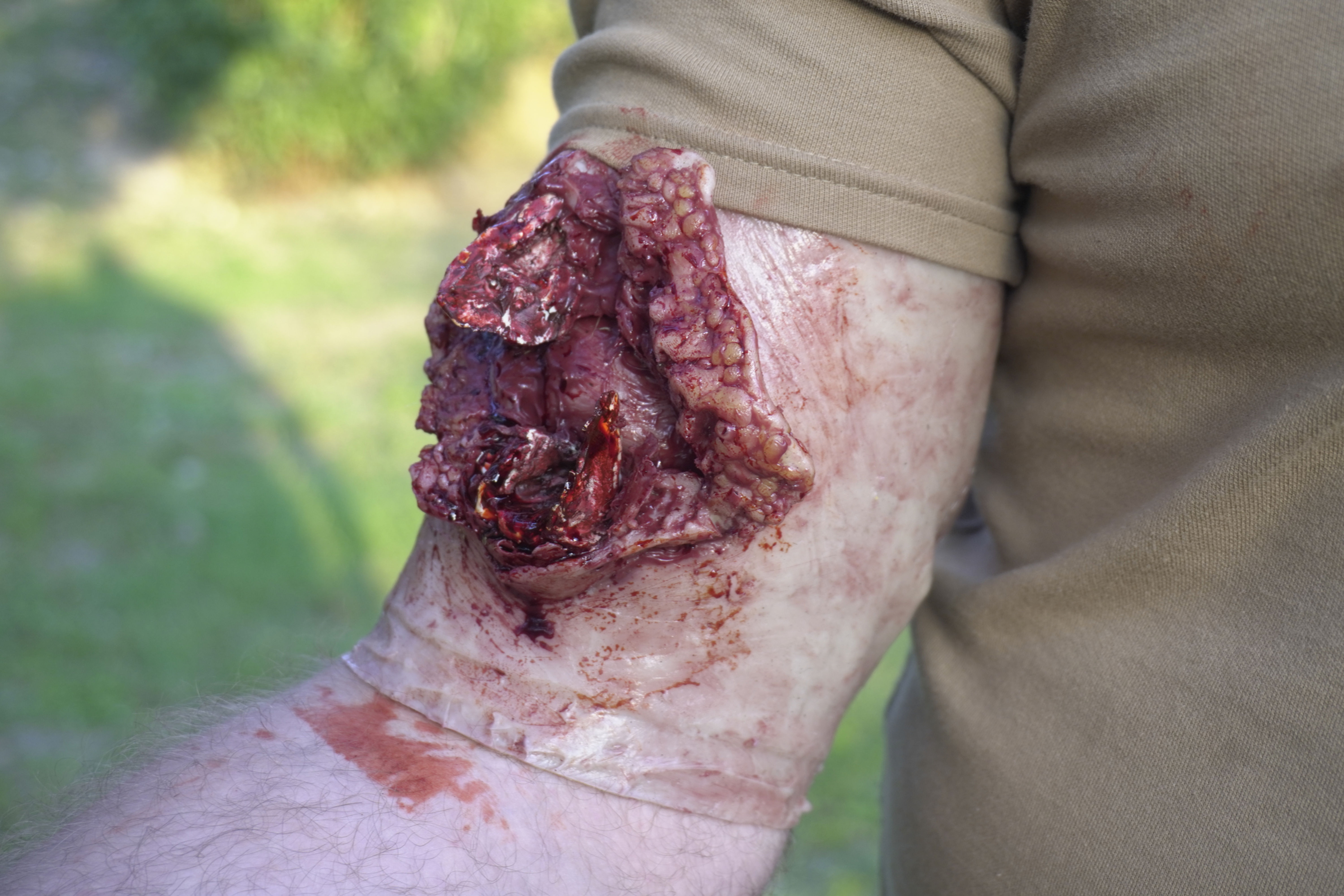 Attachable Humerus Open fracture (Hard bone) simulator with bleeding set