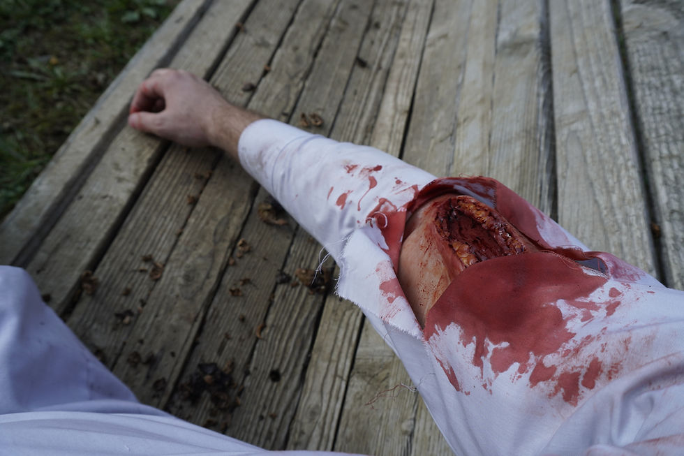 Thumbnail: Laceration wound (Arm, thigh & lower leg)