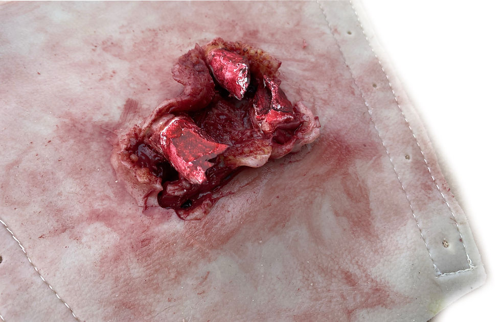 Thumbnail: Forearm Open Fracture