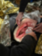 Thumbnail: Abdominal injury with intestines