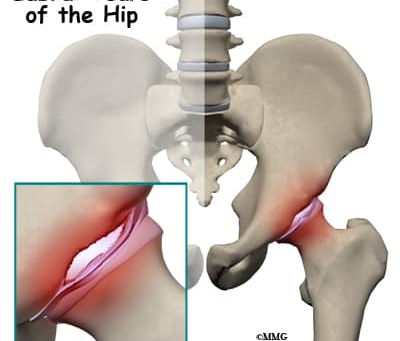 🌟 Hip Labral Tears: The Benefits of Physical Therapy 🌟
