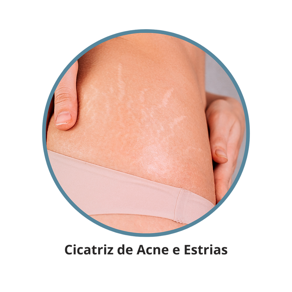 Cicatriz de Acne e Estrias
