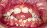 tonguethrust1.GIF