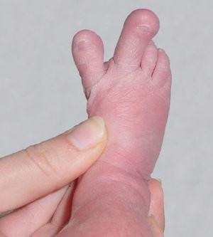 macrodactilia, dedos gigantes, Proteus,