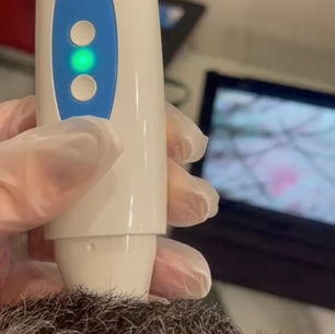 Mão da Hérika Olliveira realizando avaliação de queda de cabelo em couro cabeludo