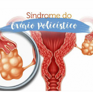 A SOP (Síndrome do Ovário Policístico) pode estar afetando os seus fios!