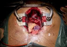 Cirugía cardiovascular.jpeg