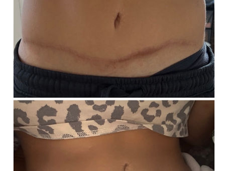 The Healing Art of Paramedical Tattooing: Restoring Confidence Through Skin Restoration
