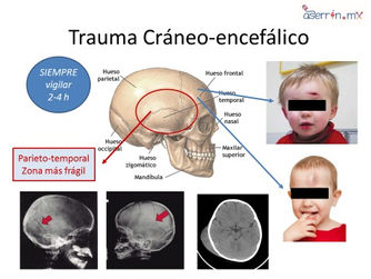 5 pasos ante las caídas de cabeza (Trauma de cráneo)