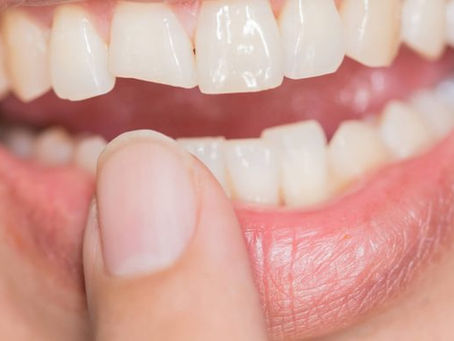 E quando o dente quebra?
