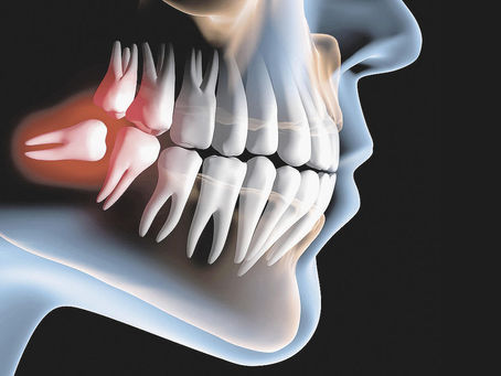 Qual dentista extrai o siso?