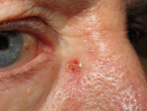 ulcerated nodular bcc skin cancer