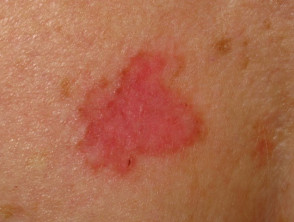 superficial bcc skin cancer