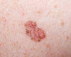 superficial basal cell BCC skin cancer